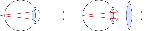 occhio presbite
